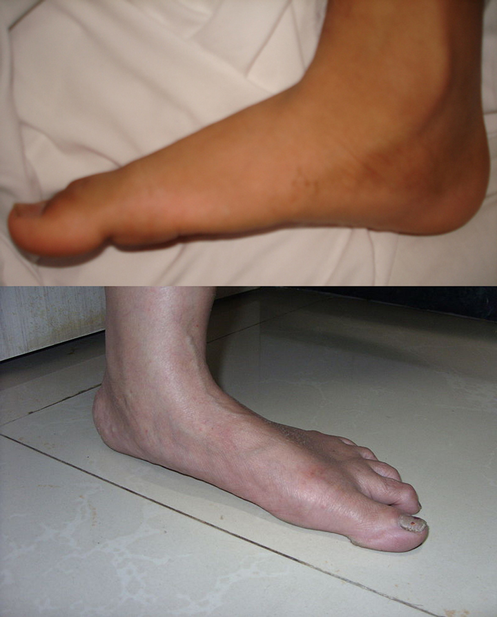 Dr. Fosdick can treat adult flat feet