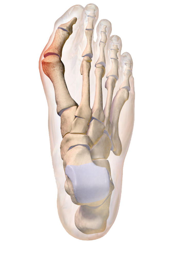 Dr. Fosdick can treat your bunions