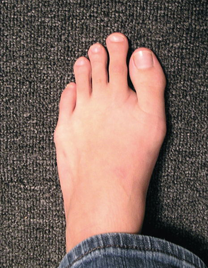Morton's Toe: Note the second toe is longer than the first.