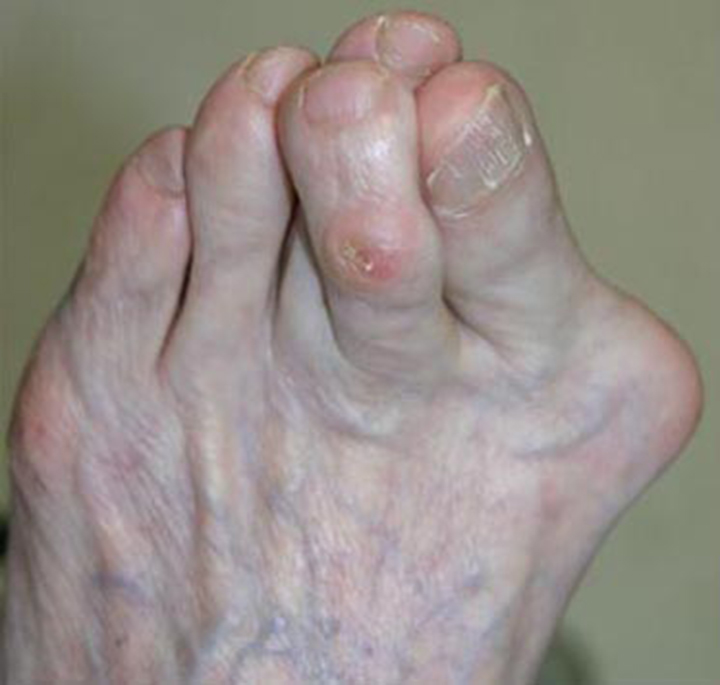 Overlapping toes that have been caused by improper shoes.