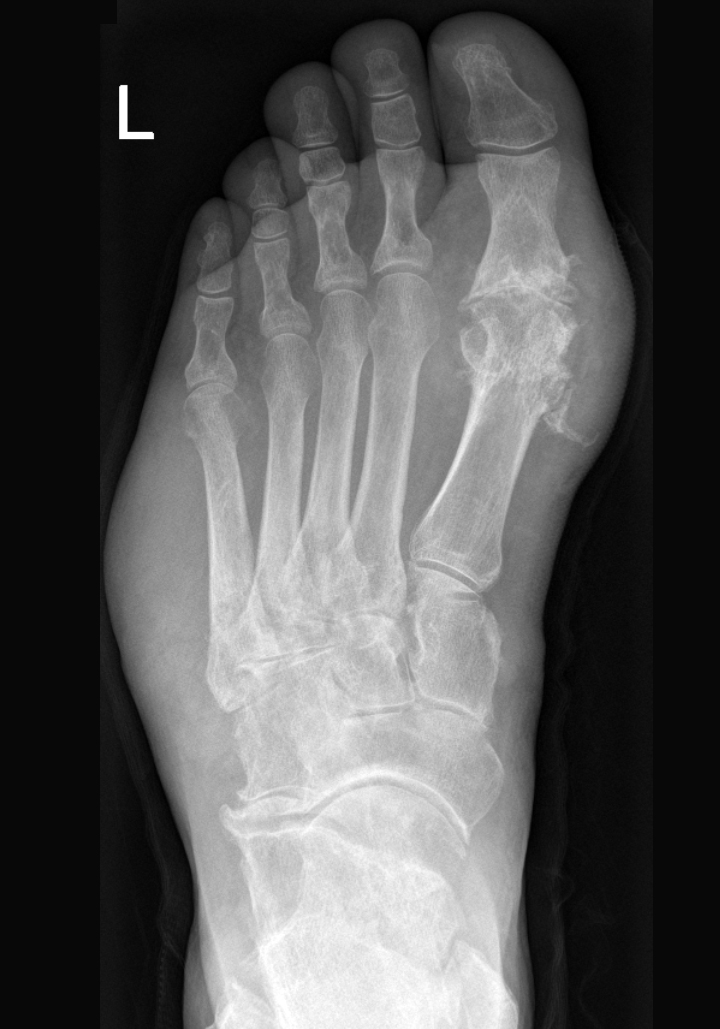 Dr. Fosdick can help you with gout