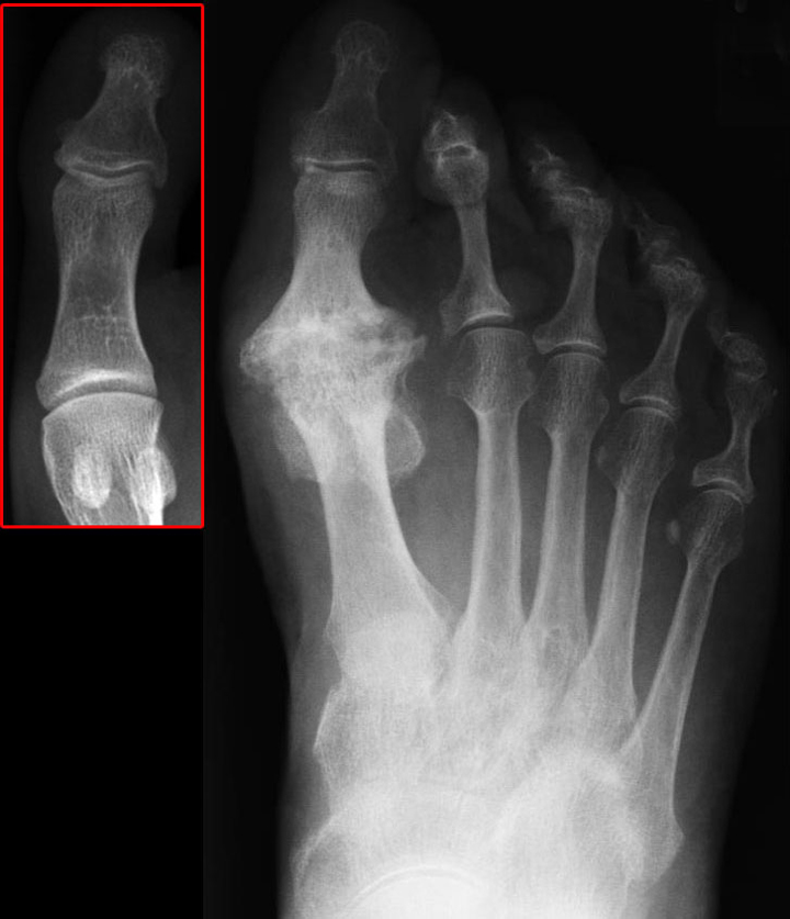 An X-Ray of Hallus Rigidus or frozen toe. Dr. Fosdick can treat this condition
