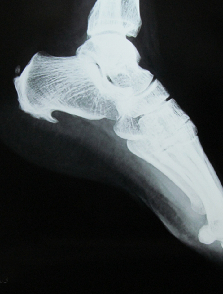 A Heel Spur may be an indication of something more serious, like plantar fasciitis