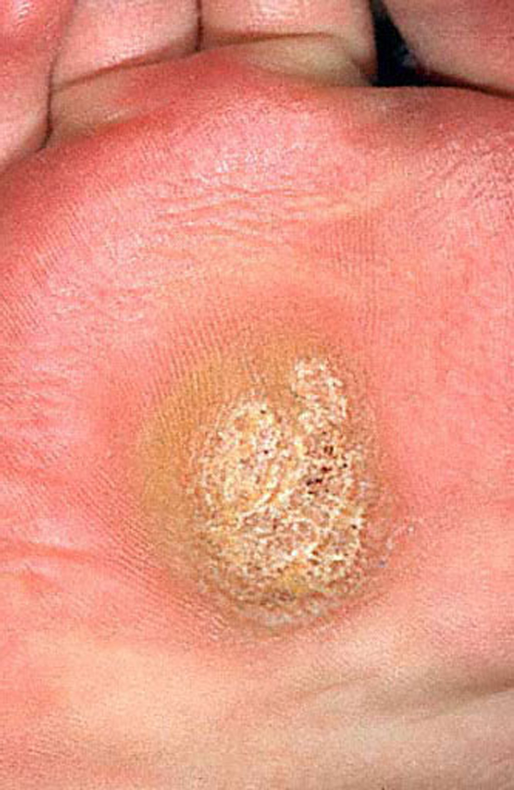 Dr. Fosdick can remove plantar warts so that they do not become painful.