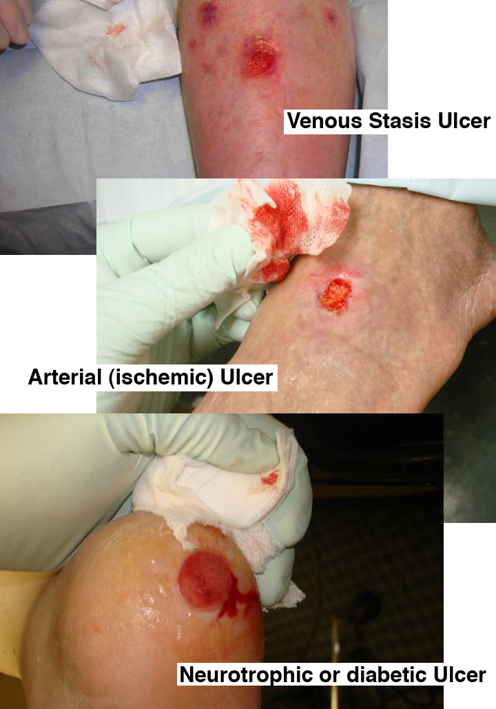 The three types of ulcers common to the ankle and foot.